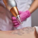Laserowe usuwanie tatuażu - przewodnik krok po kroku