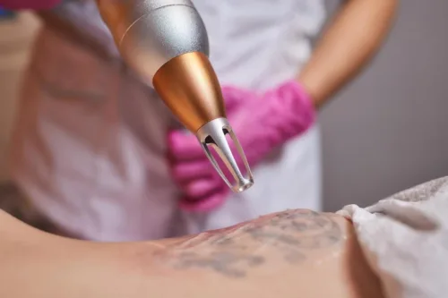 Laserowe usuwanie tatuażu – przewodnik krok po kroku